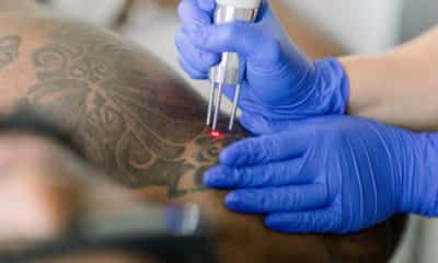 St. Pete commission advances plan for medical tattoos